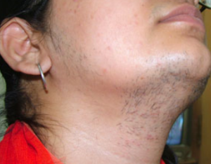 Facial Female Hair 96